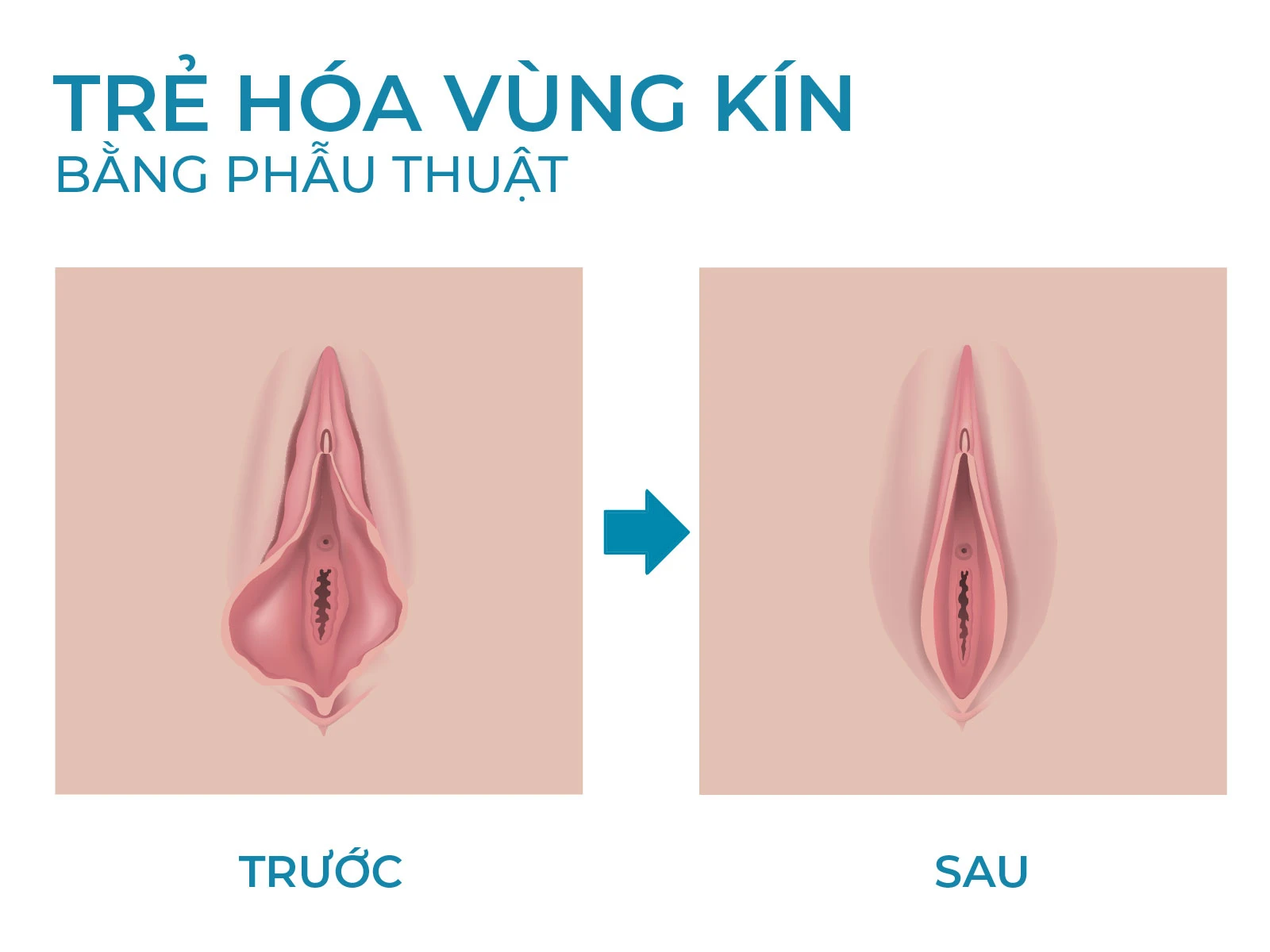 Những Đối Tượng Nào Nên Thực Hiện Tạo Hình Âm Đạo?