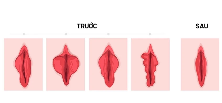 Thẩm mỹ, trẻ hoá vùng kín có những phương pháp nào?