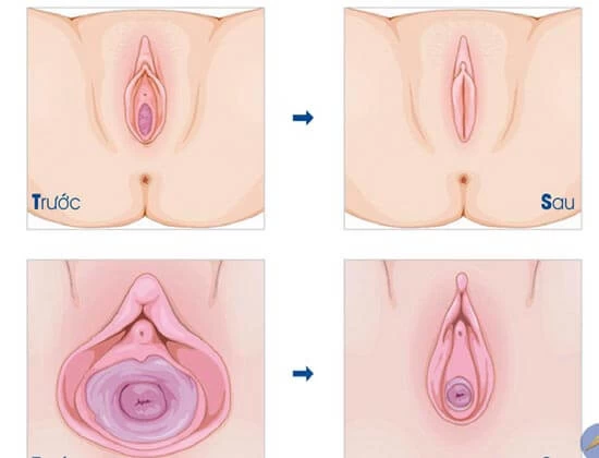 Âm đạo sau sinh thay đổi như thế nào? Nguyên nhân và cách khắc phục hiệu quả
