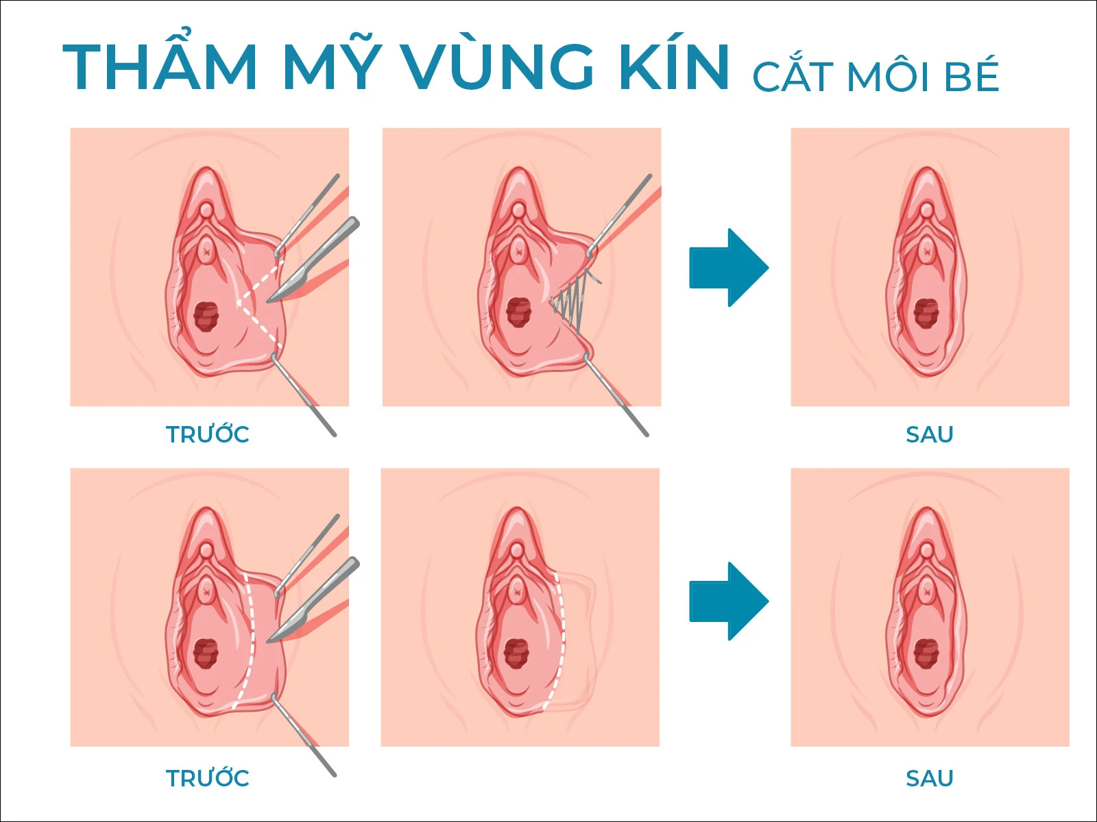 NGƯỜI PHỤ NỮ BỊ CẮT MẤT MỘT PHẦN “CÔ BÉ” VÀ SƯNG NỀ, THÂM TÍM MÔI LỚN SAU KHI ĐI THẨM MỸ VÙNG KÍN 